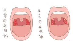 扁桃体炎会有哪些危害