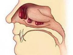 重庆仁品耳鼻喉医院_鼻息肉的常见症状有哪些