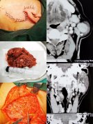 65岁患者慕名求治“腮腺肿物”，却被劝说回了家