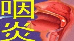 久治不愈的咽喉异物感、声嘶咽痛、痰多咳嗽，病根可能是它！