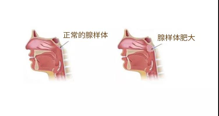 腺样体肥大