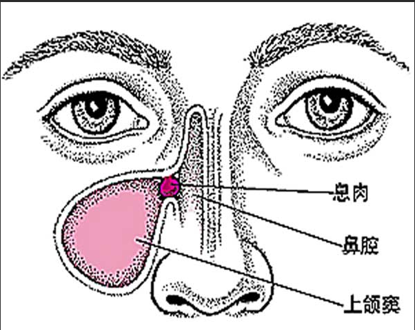 重庆看鼻息肉医院哪家好