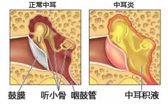 中耳炎的预防方法—重庆仁品耳鼻喉医院