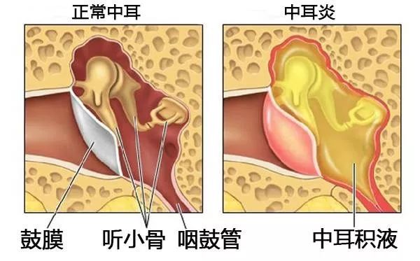 中耳炎的预防方法