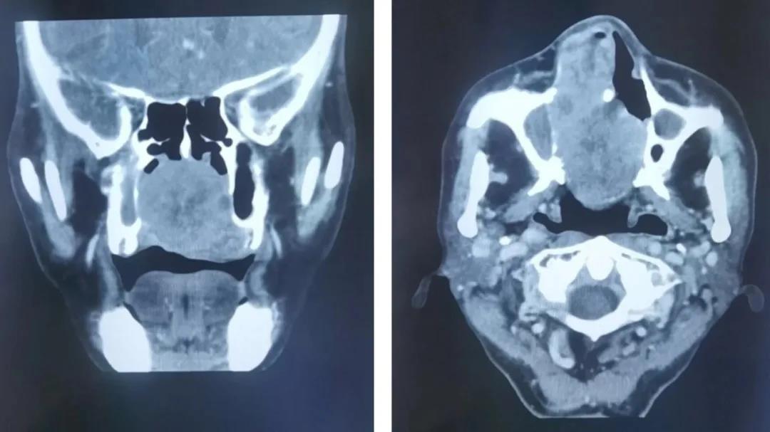 鼻腔多形性腺瘤